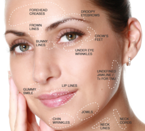 botox treatment areas