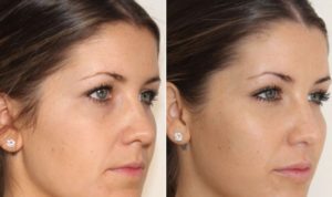 dermal filler to cheek bones