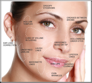 dermal filler treatment areas