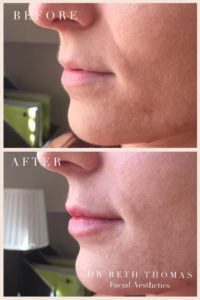 lip filler before after